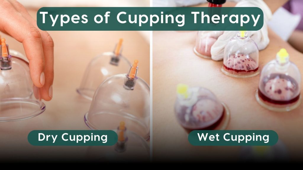 Comparison of dry cupping and wet cupping therapy, showing clear suction cups on skin for dry cupping and blood-filled cups for wet cupping.
