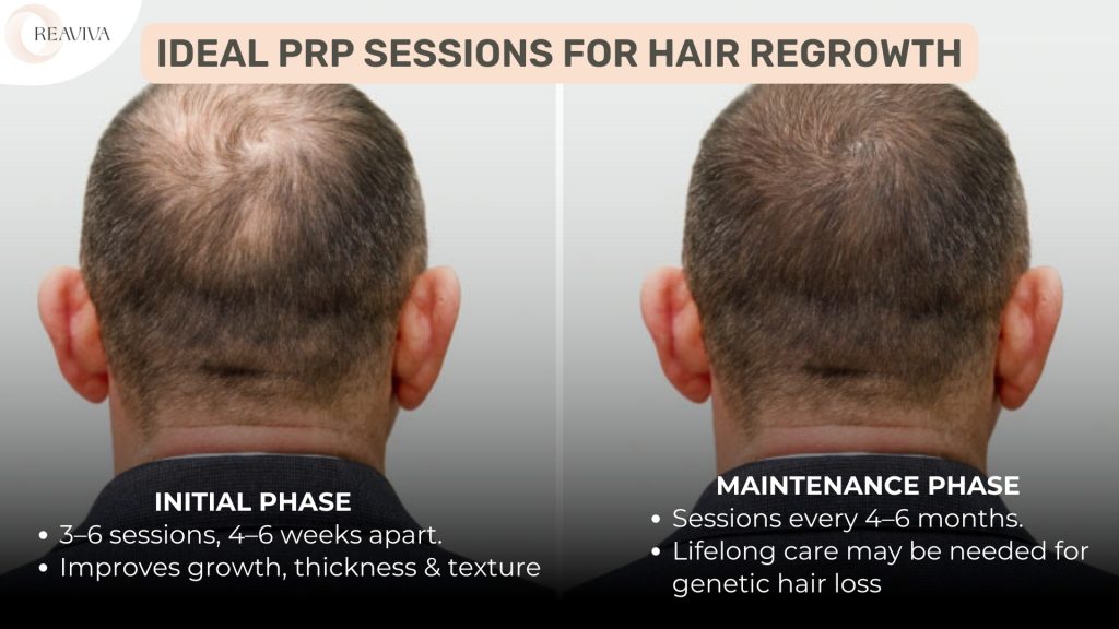 Before and after comparison of PRP (Platelet-Rich Plasma) therapy for hair regrowth, showing visible improvement in hair density. The left side represents the initial phase, where 3-6 PRP sessions are conducted every 4-6 weeks to enhance hair growth, thickness, and texture. The right side highlights the maintenance phase, requiring sessions every 4-6 months to sustain results. The infographic explains that individuals with genetic hair loss may need ongoing PRP treatments for long-term benefits.